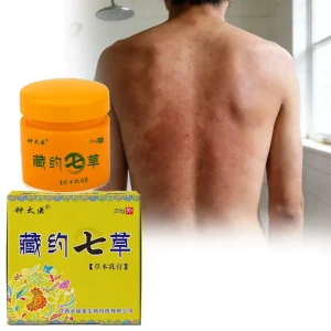 Dermatitis Antipruritic Cream Mosquito Bite Skin Tinea Antipruritic Cream